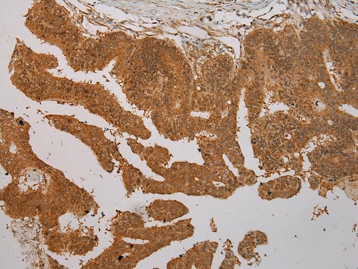 Immunohistochemical analysis of paraffin-embedded Human Colorectal cancer tissue using #40331 at dilution 1/100.