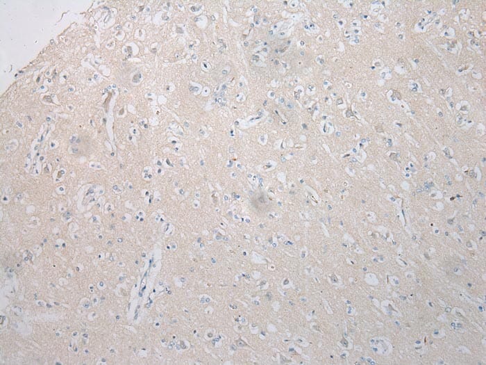 Immunohistochemical analysis of paraffin-embedded Human Brain cancer tissue using #40340 at dilution 1/200.