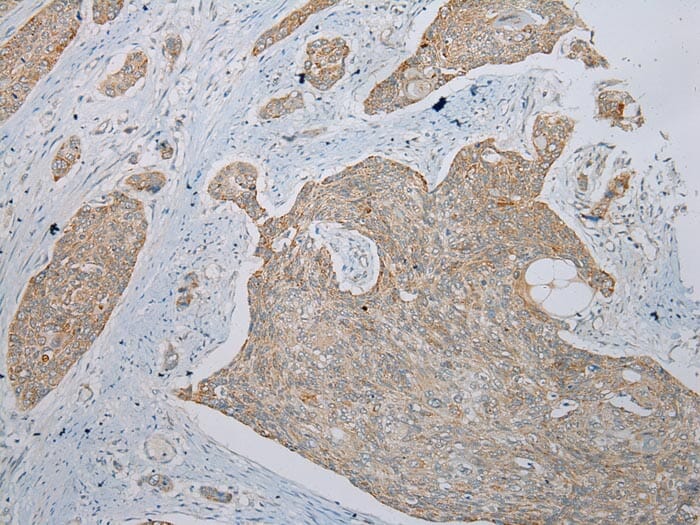 Immunohistochemical analysis of paraffin-embedded Human Oesophagus cancer tissue using #40344 at dilution 1/200.