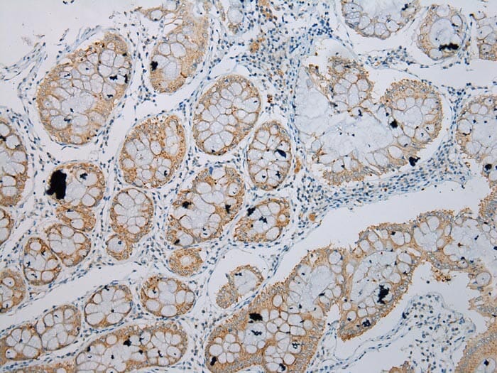 Immunohistochemical analysis of paraffin-embedded Human Colorectal cancer tissue using #40344 at dilution 1/200.