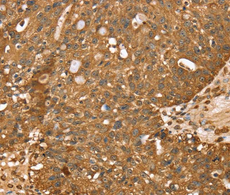 Immunohistochemical analysis of paraffin-embedded Human breast cancer tissue using #40375 at dilution 1/40.