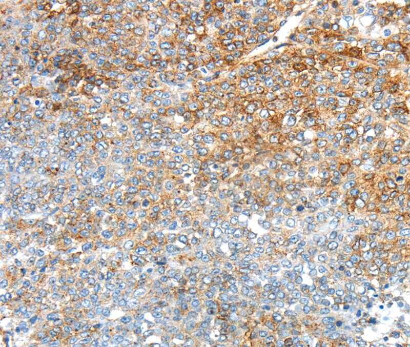 Immunohistochemical analysis of paraffin-embedded Human ovarian cancer tissue using #40392 at dilution 1/30.