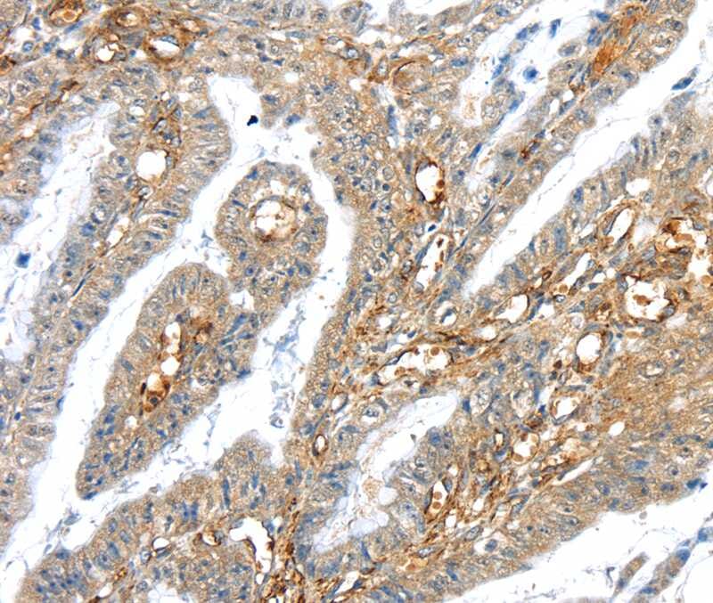 Immunohistochemical analysis of paraffin-embedded Human oesophagus cancer tissue using #40392 at dilution 1/30.