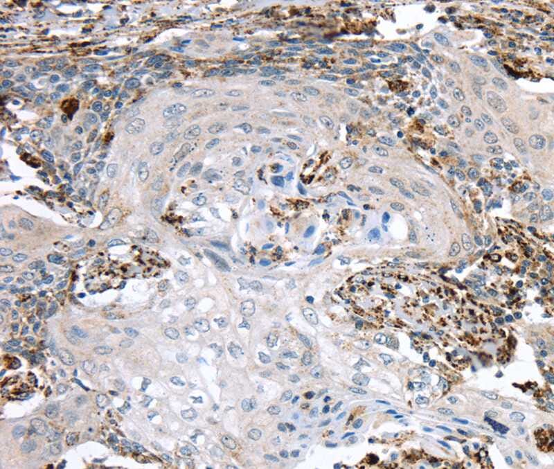 Immunohistochemical analysis of paraffin-embedded Human cervical cancer tissue using #40396 at dilution 1/40.