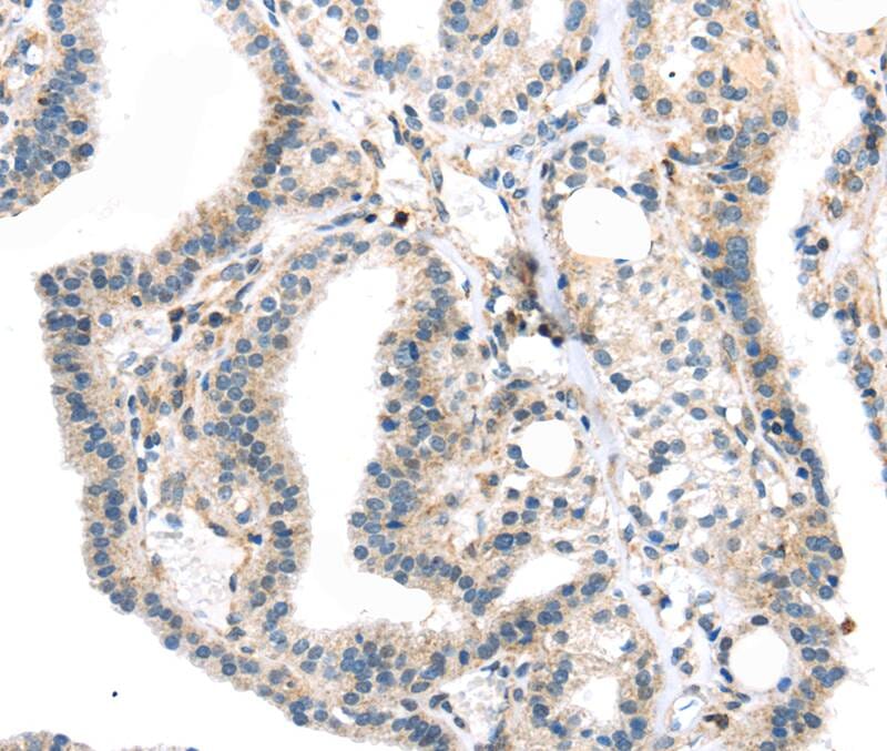 Immunohistochemical analysis of paraffin-embedded Human thyroid cancer tissue using #40396 at dilution 1/40.