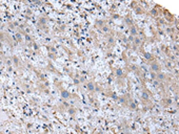 Immunohistochemical analysis of paraffin-embedded Human liver cancer tissue using #43366 at dilution 1/20,