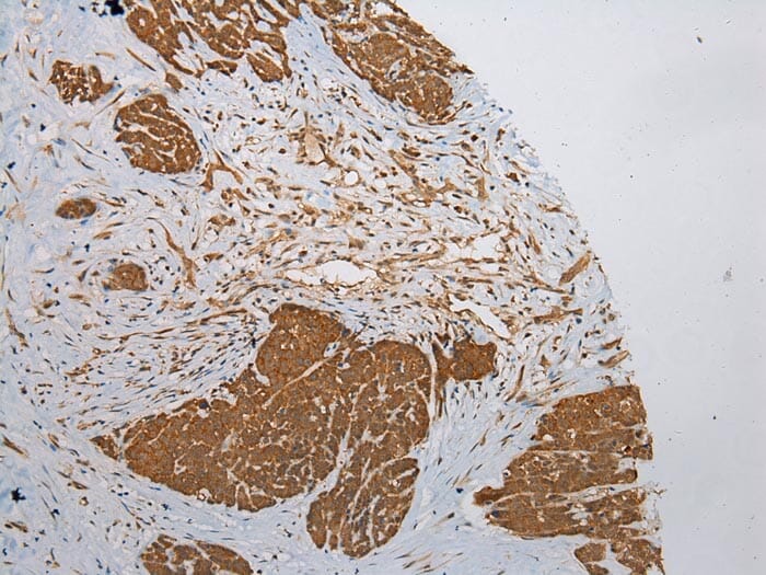Immunohistochemical analysis of paraffin-embedded Human Thyroid cancer tissue using #43372 at dilution 1/200.