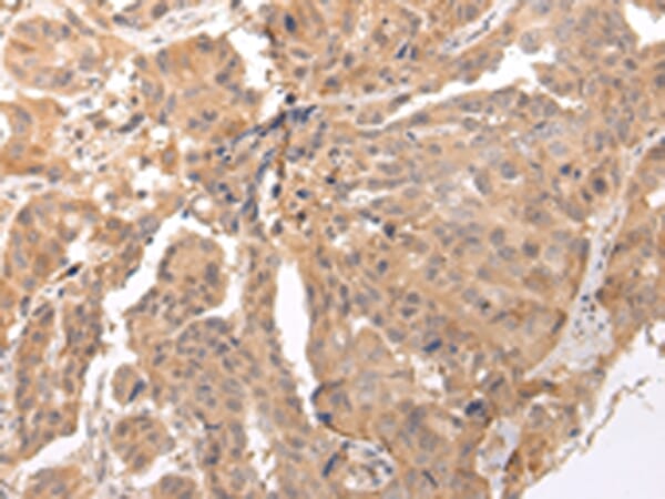 Immunohistochemical analysis of paraffin-embedded Human breast cancer tissue using #43448 at dilution 1/45,