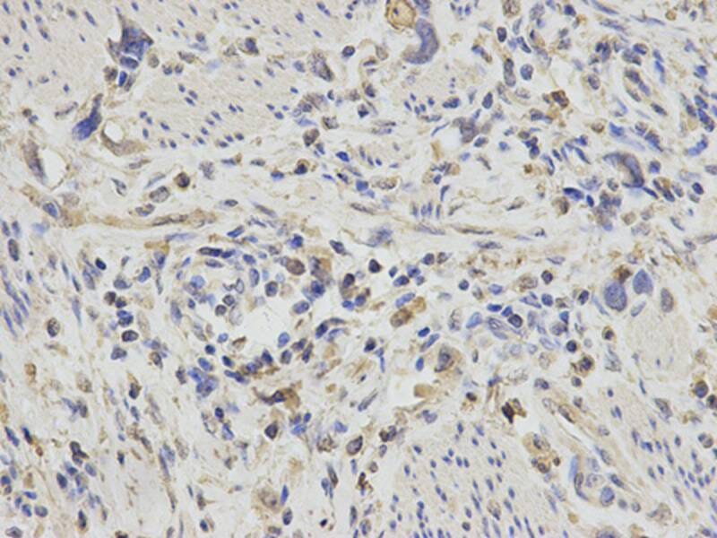 Immunohistochemical analysis of paraffin-embedded human stomach cancer using PDGFB antibody at dilution of 1: 200 (400x lens).