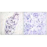 Immunohistochemical analysis of paraffin-embedded human lung carcinoma tissue using HDAC1 antibody #33398.
