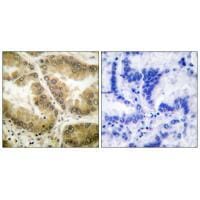 Immunohistochemical analysis of paraffin-embedded human lung carcinoma tissue using HDAC7 antibody #33402.