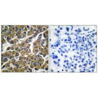 Immunohistochemical analysis of paraffin-embedded human breast carcinoma tissue using MMP-3 antibody #33443.
