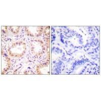 Immunohistochemistry analysis of paraffin-embedded human lung carcinoma tissue using NEDD8 antibody #33513.