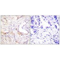 Immunohistochemistry analysis of paraffin-embedded human lung carcinoma tissue using PIAS3 antibody #33517.
