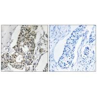 Immunohistochemistry analysis of paraffin-embedded human breast carcinoma tissue using RIMS4 antibody #34978.