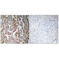 Immunohistochemistry analysis of paraffin-embedded human lung carcinoma tissue, using TBPL2 antibody #35184.