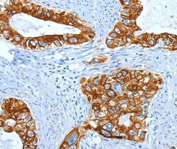 Immunohistochemical analysis of paraffin-embedded Human cervical cancer tissue using #35629 at dilution 1/50.