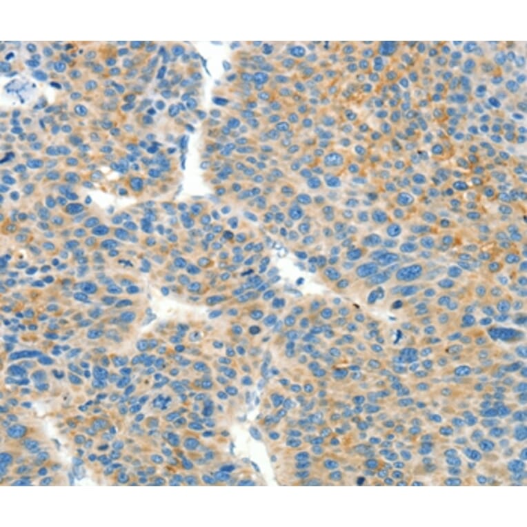 Immunohistochemistry - BCAT1 Antibody from Signalway Antibody (36276) - Antibodies.com