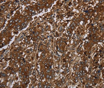 Immunohistochemical analysis of paraffin-embedded Human liver cancer tissue using #37690 at dilution 1/30.