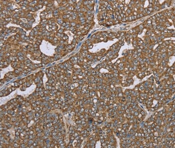 Immunohistochemical analysis of paraffin-embedded Human ovarian cancer tissue using #37696 at dilution 1/35.