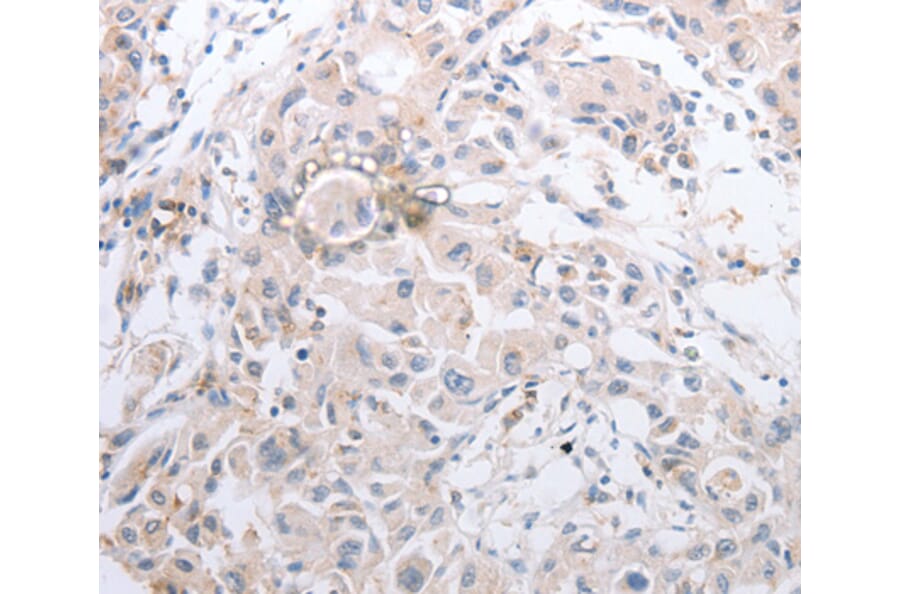 Immunohistochemistry - MMP11 antibody from Signalway Antibody (38546) - Antibodies.com