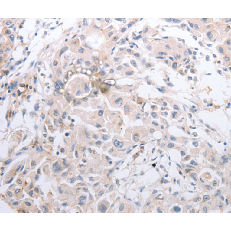 Immunohistochemistry - MMP11 antibody from Signalway Antibody (38546) - Antibodies.com