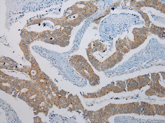Immunohistochemical analysis of paraffin-embedded Human Colorectal cancer tissue using #40058 at dilution 1/200.