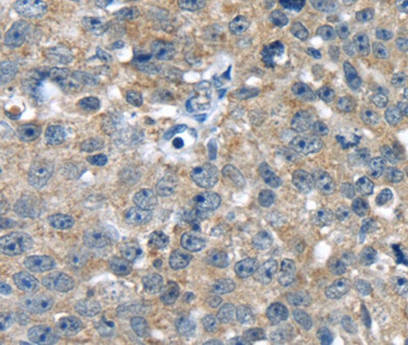 Immunohistochemical analysis of paraffin-embedded Human breast cancer tissue using #40366 at dilution 1/20.