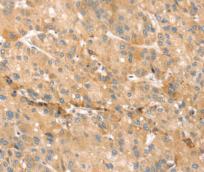 Immunohistochemical analysis of paraffin-embedded Human liver cancer tissue using #40386 at dilution 1/30.