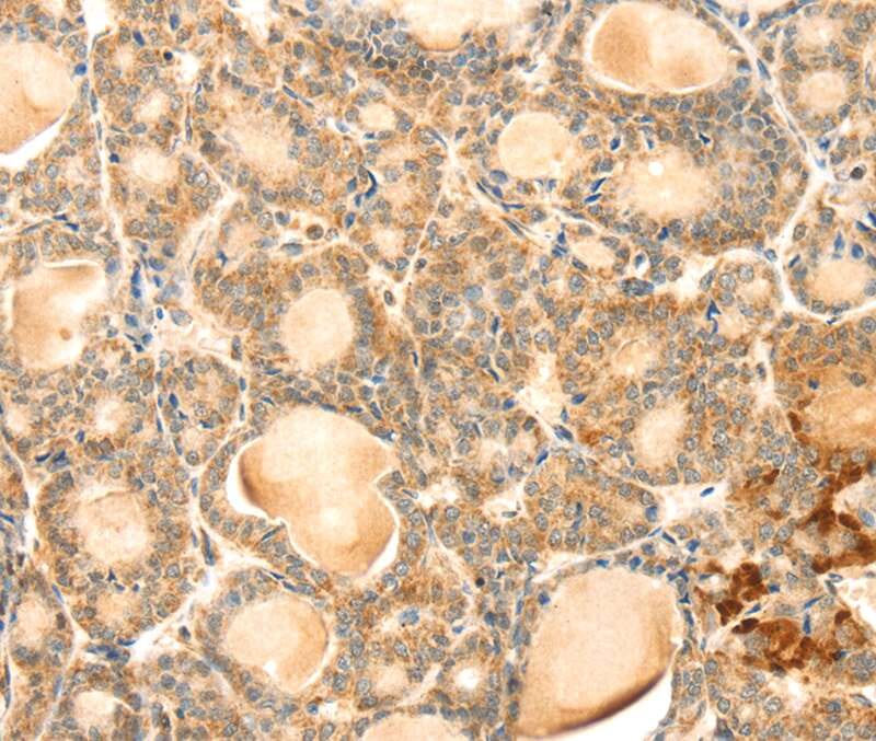 Immunohistochemical analysis of paraffin-embedded Human thyroid cancer tissue using #40386 at dilution 1/30.