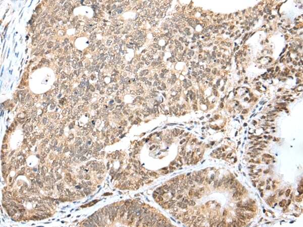 Immunohistochemical analysis of paraffin-embedded Human gastric cancer tissue using #43292 at dilution 1/20.