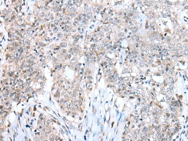Immunohistochemical analysis of paraffin-embedded Human oesophagus cancer tissue using #43292 at dilution 1/20.