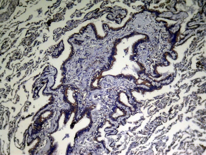 Immunohistochemical analysis of paraffin-embedded Human Lung cancer tissue using #43347 at dilution 1/200,