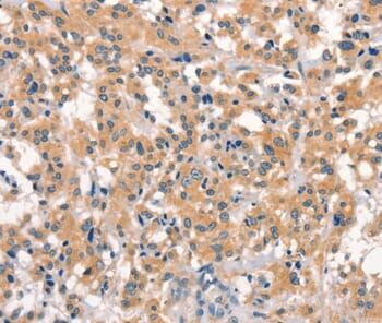 Immunohistochemical analysis of paraffin-embedded Human thyroid cancer tissue using #37542 at dilution 1/15.