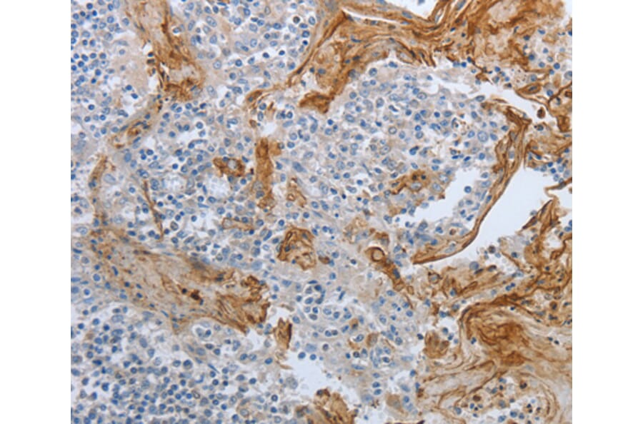 Immunohistochemistry - BRAF antibody from Signalway Antibody (38525) - Antibodies.com