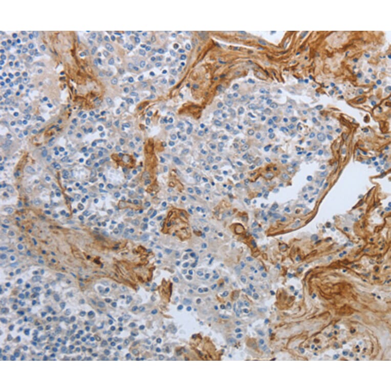Immunohistochemistry - BRAF antibody from Signalway Antibody (38525) - Antibodies.com