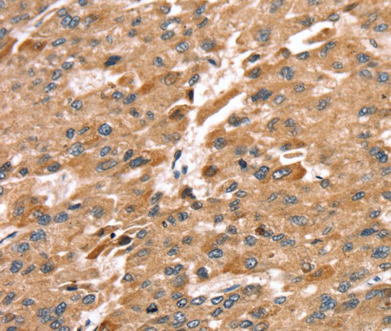 Immunohistochemical analysis of paraffin-embedded Human liver cancer tissue using #40231 at dilution 1/30.