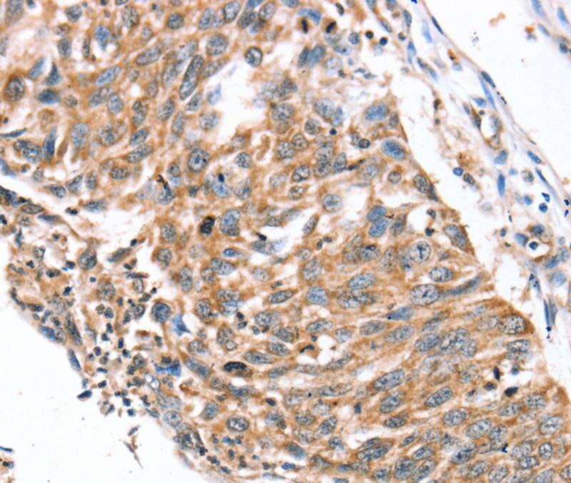 Immunohistochemical analysis of paraffin-embedded Human lung cancer tissue using #40231 at dilution 1/30.