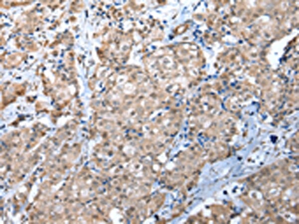 Immunohistochemical analysis of paraffin-embedded Human breast cancer tissue using #42846 at dilution 1/30,