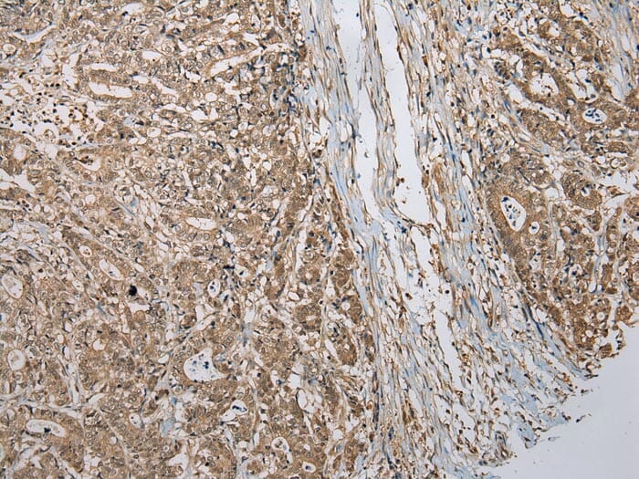 Immunohistochemical analysis of paraffin-embedded Human Colorectal cancer tissue using #42897 at dilution 1/200.