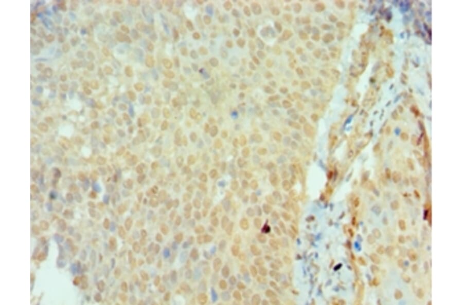 Immunohistochemistry - SSX2 Polyclonal Antibody from Signalway Antibody (42646) - Antibodies.com