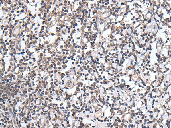 The image on the left is immunohistochemistry of paraffin-embedded Human tonsil tissue using PLAG1 Antibody at dilution 1/25, on the right is treated with synthetic peptide. (Original magnification: x200)
