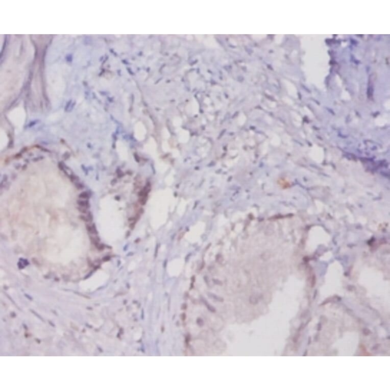 Immunohistochemistry - Mucin-16 Polyclonal Antibody from Signalway Antibody (42528) - Antibodies.com