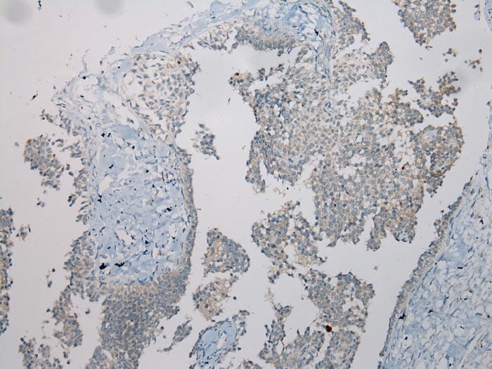 Immunohistochemical analysis of paraffin-embedded Human Ovarian cancer tissue using #40394 at dilution 1/100.