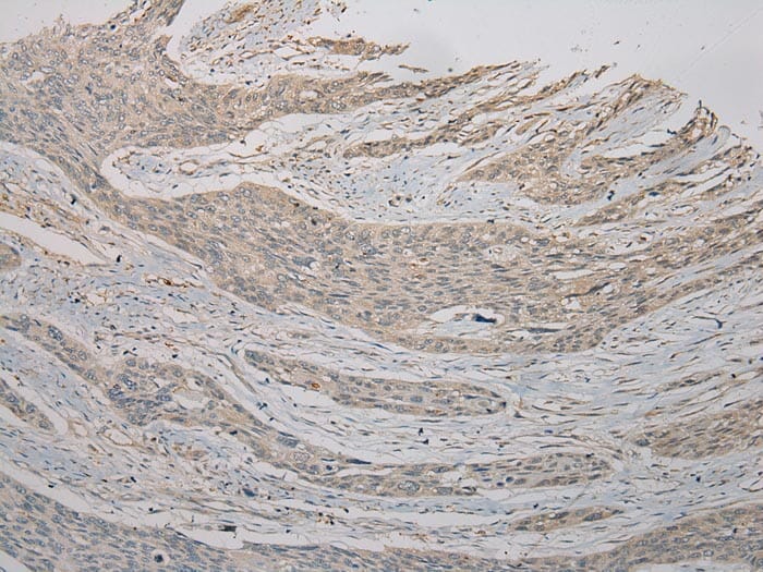 Immunohistochemical analysis of paraffin-embedded Human Oesophagus cancer tissue using #40394 at dilution 1/100.