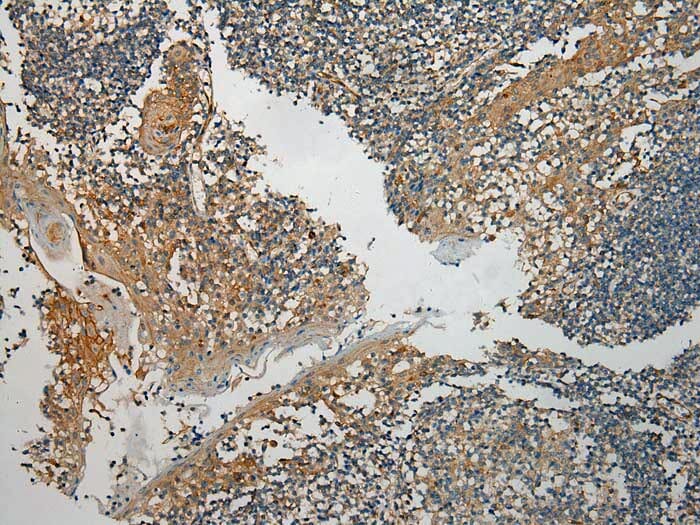Immunohistochemical analysis of paraffin-embedded Human Tonsil cancer tissue using #40160 at dilution 1/100.
