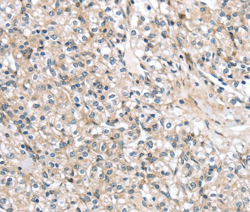 Immunohistochemical analysis of paraffin-embedded Human prostate cancer tissue using #40162 at dilution 1/20.