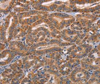 Immunohistochemical analysis of paraffin-embedded Human oesophagus cancer tissue using #36047 at dilution 1/20.