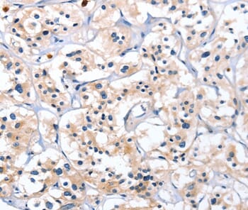 Immunohistochemical analysis of paraffin-embedded Human thyroid cancer tissue using #36313 at dilution 1/40.