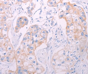 Immunohistochemical analysis of paraffin-embedded Human breast cancer tissue using #37313 at dilution 1/50.